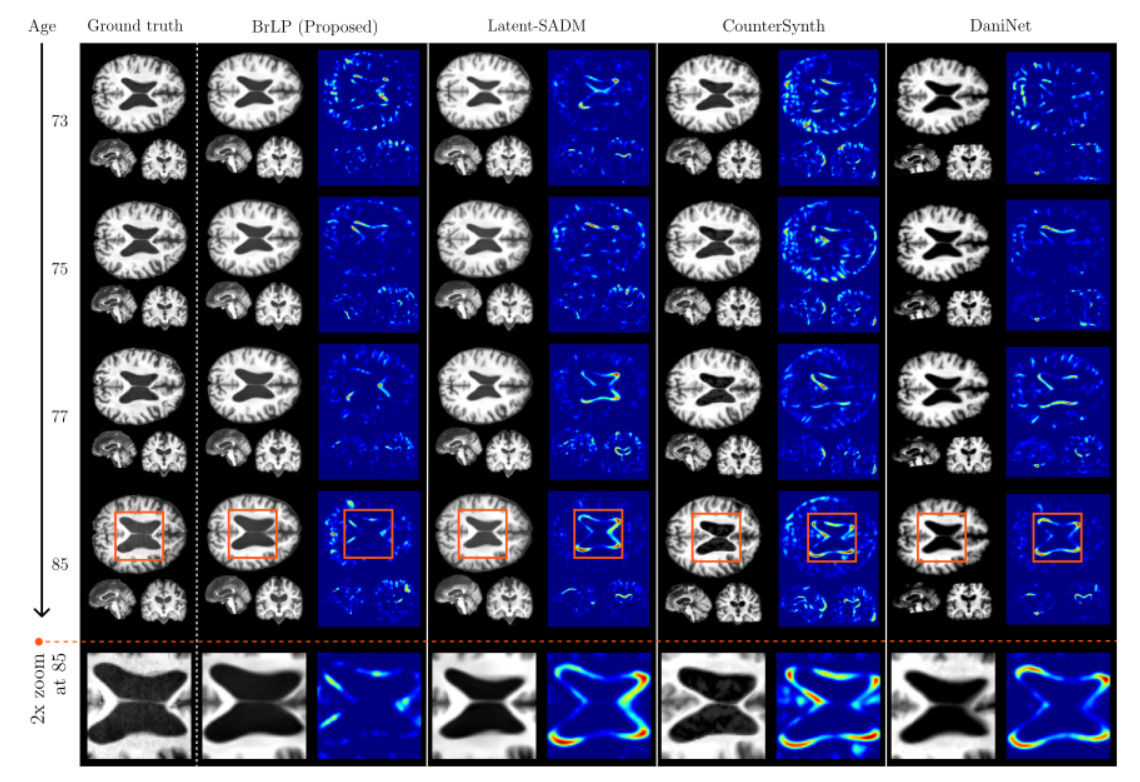 Comparison between the real progression of a subject and the predictions obtained by BrLP and baseline methods